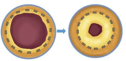 Drug Coating Coroanry Balloon